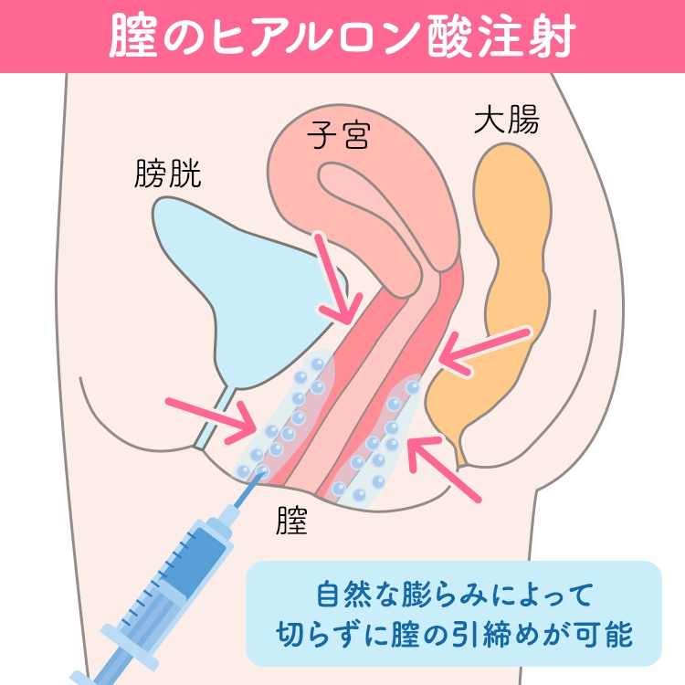 膣ヒアルロン酸