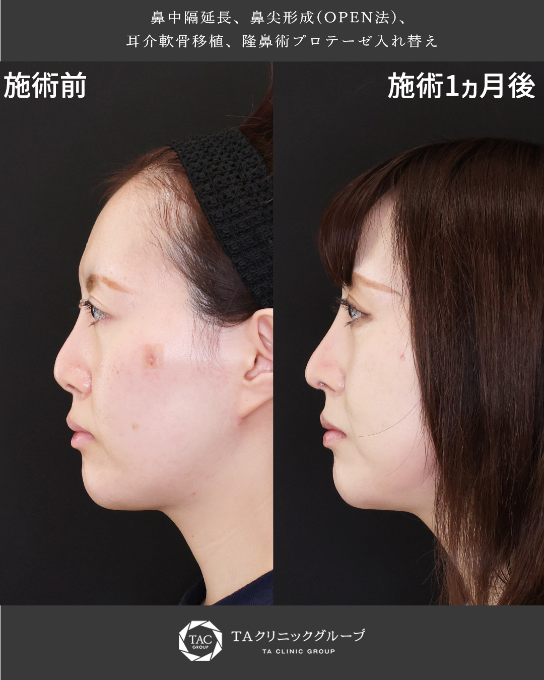 鼻先を下げて、鼻孔が目立たない自然な鼻に。