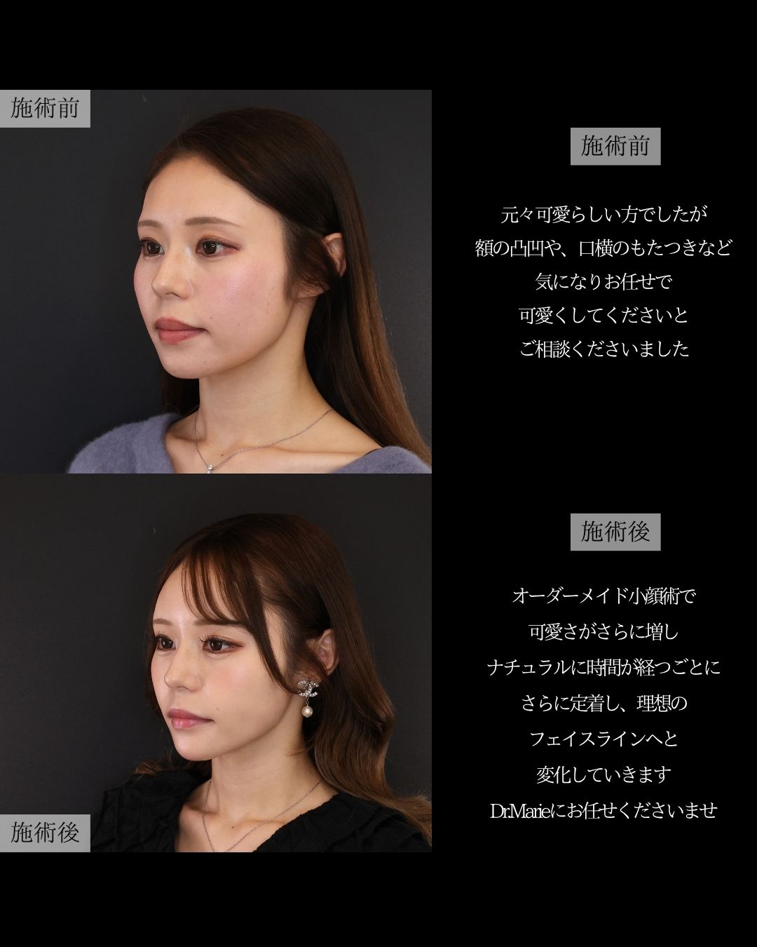 ジョールファット除去/エラボトックス注射/顔の脂肪吸引の症例写真 施術前後 