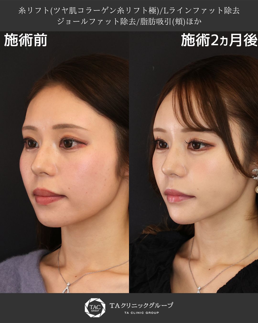 銀座院院長 山田真里江による輪郭美を極めるトータルデザイン施術