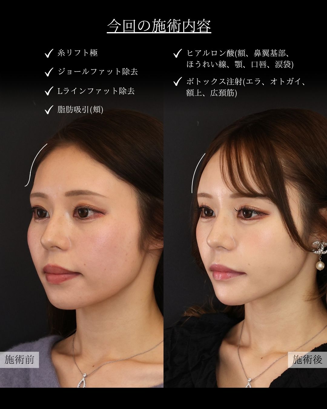 ジョールファット除去/エラボトックス注射/顔の脂肪吸引の症例写真 施術前後 