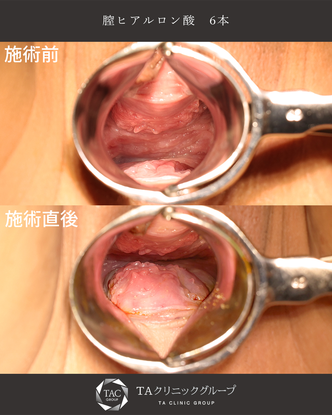 【膣ヒアルロン酸】感度や締まりを美容医療で改善！