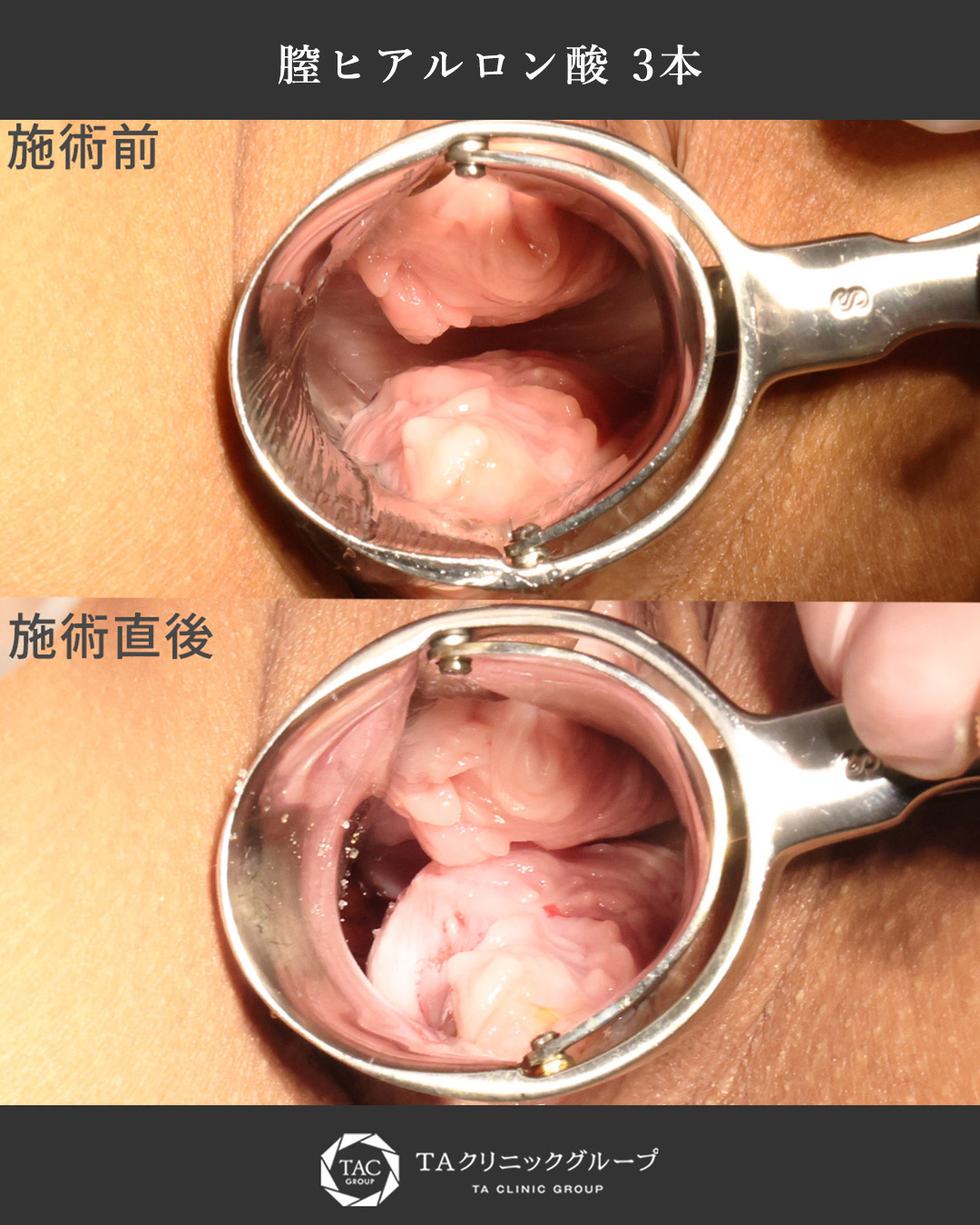 【術直後症例】膣ヒアルロン酸注入で膣ゆるみのお悩み解決！