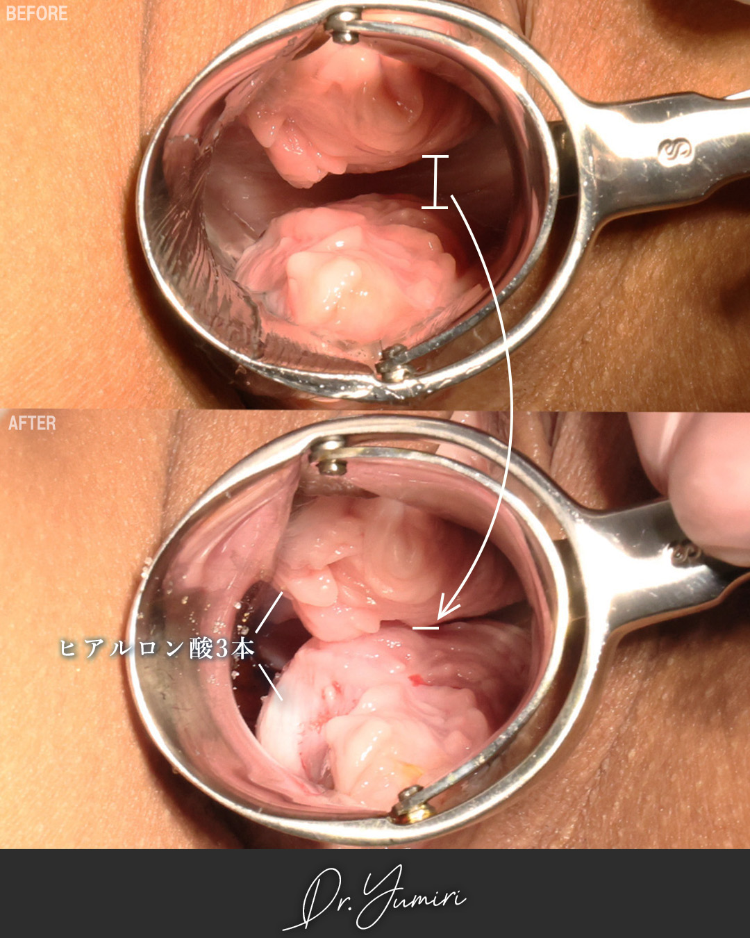 膣縮小術の症例写真 施術前後 