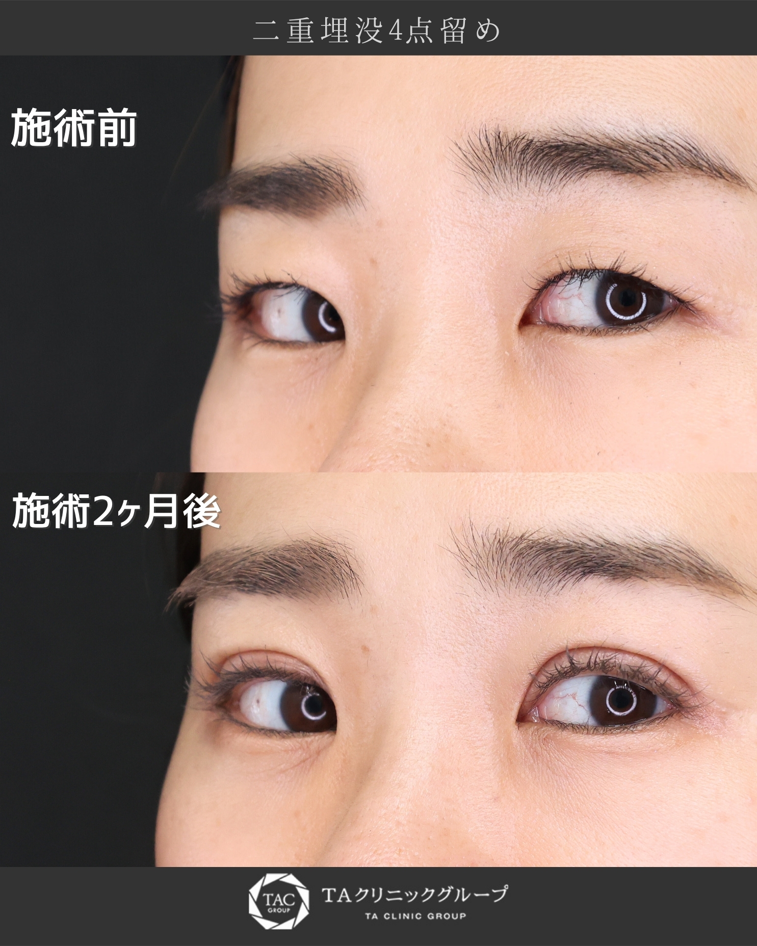 二重埋没法の症例写真 施術前後 