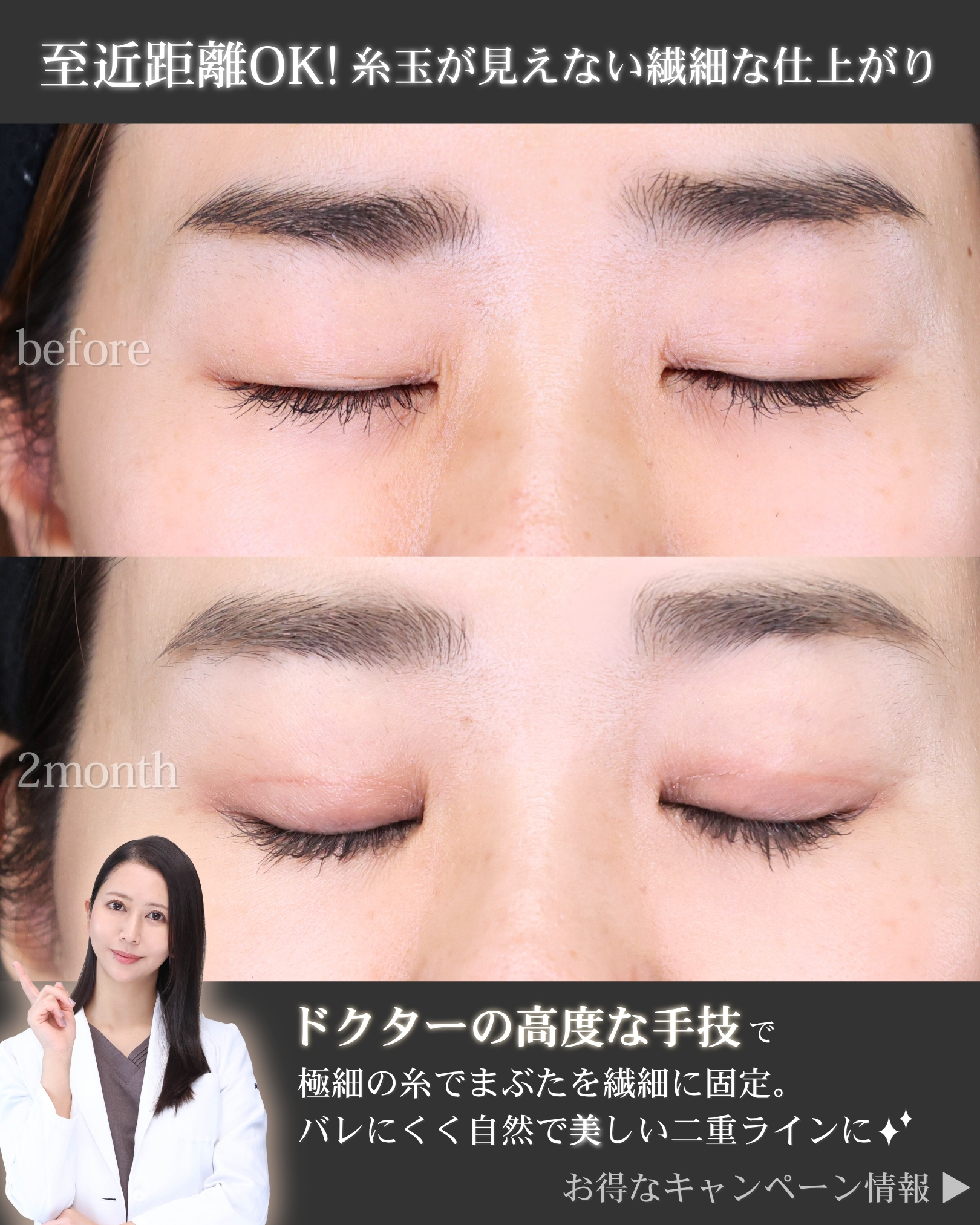 二重埋没法の症例写真 施術前後 