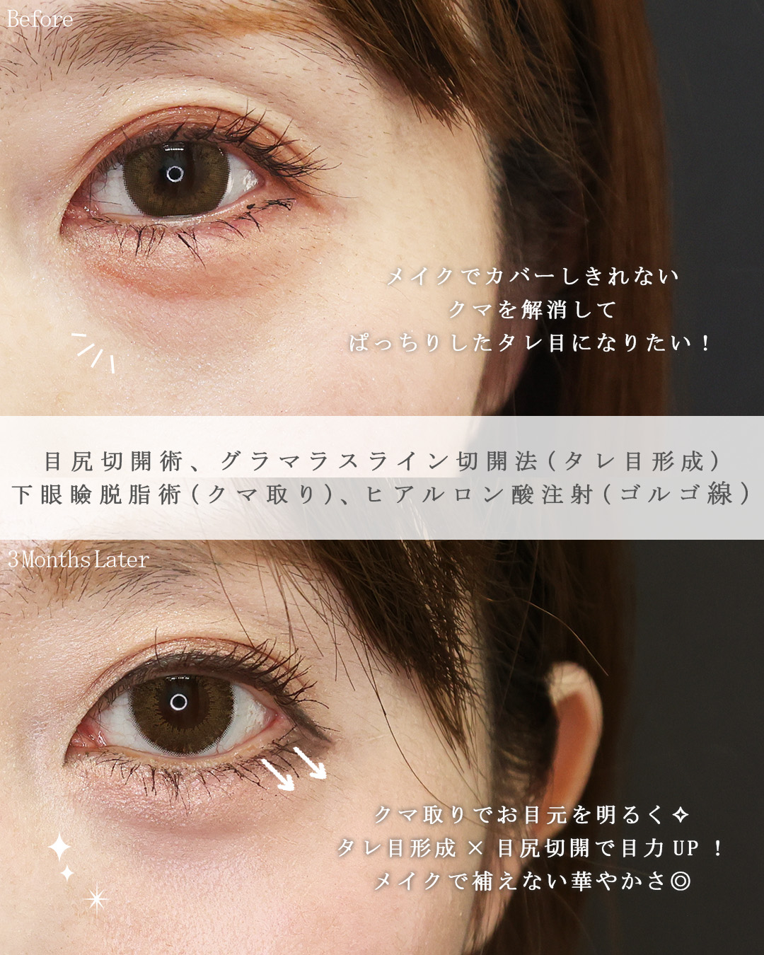 目尻切開術/グラマラスライン（タレ目形成）/下眼瞼脱脂術（目の下のたるみ取り・目の下の脂肪ふくらみ取り）の症例写真 施術前後 