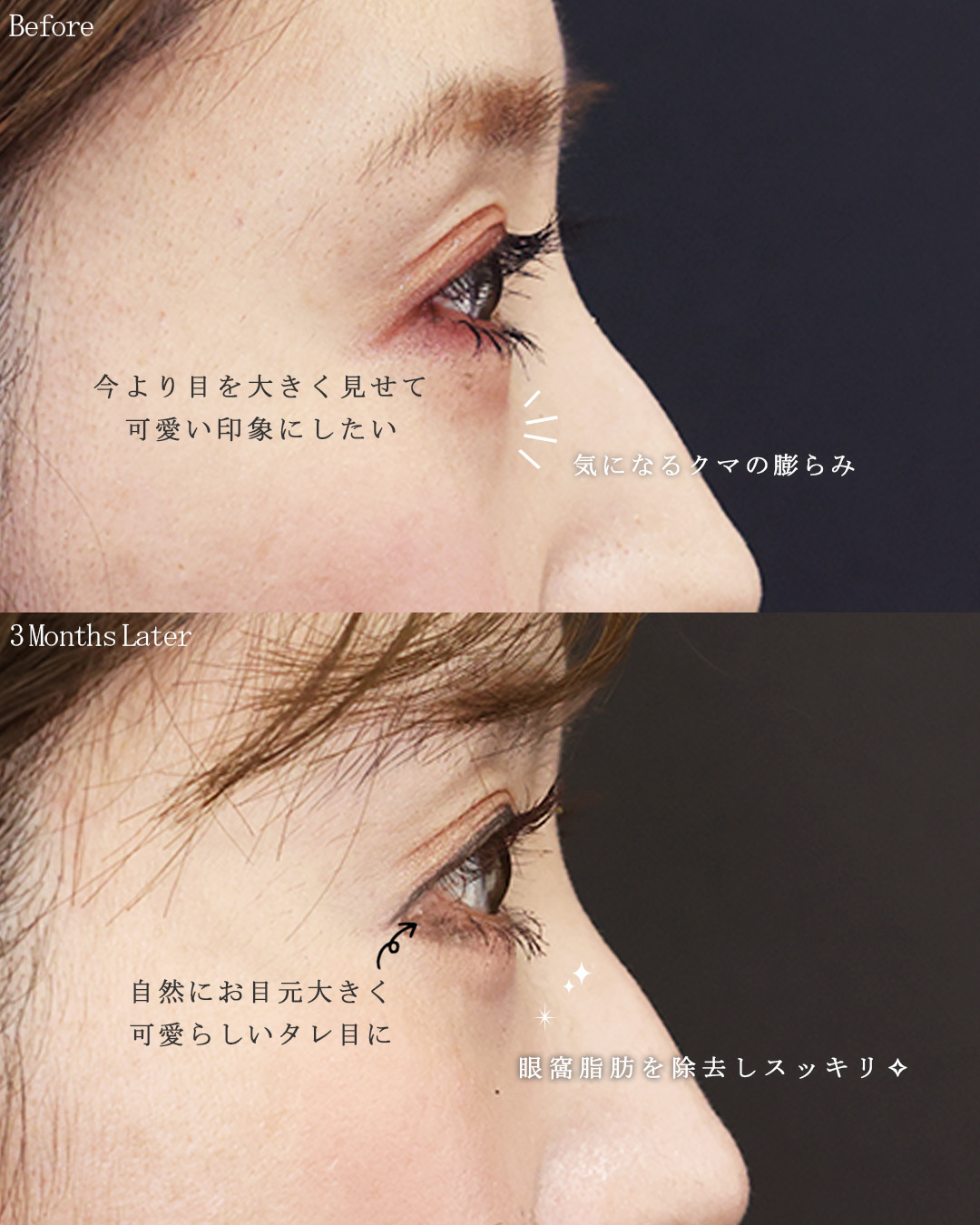 目尻切開術/グラマラスライン（タレ目形成）/下眼瞼脱脂術（目の下のたるみ取り・目の下の脂肪ふくらみ取り）の症例写真 施術前後 