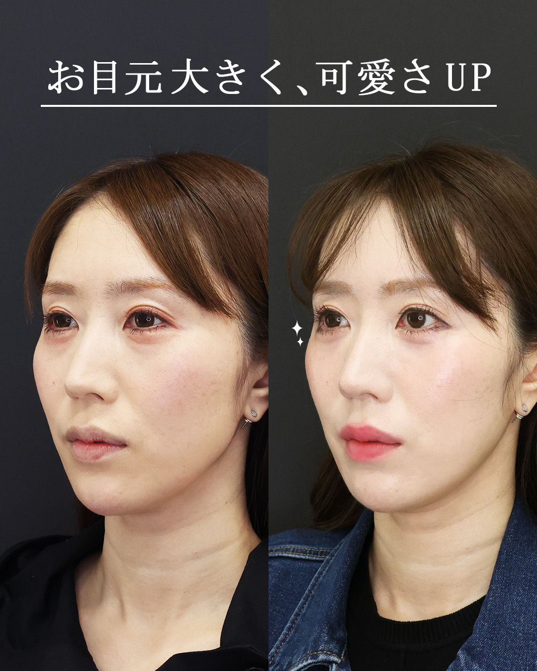 目尻切開術/グラマラスライン（タレ目形成）/下眼瞼脱脂術（目の下のたるみ取り・目の下の脂肪ふくらみ取り）の症例写真 施術前後 