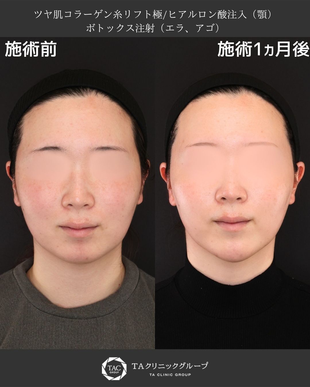 ナチュラルな輪郭補整で、小顔印象に導いた症例紹介