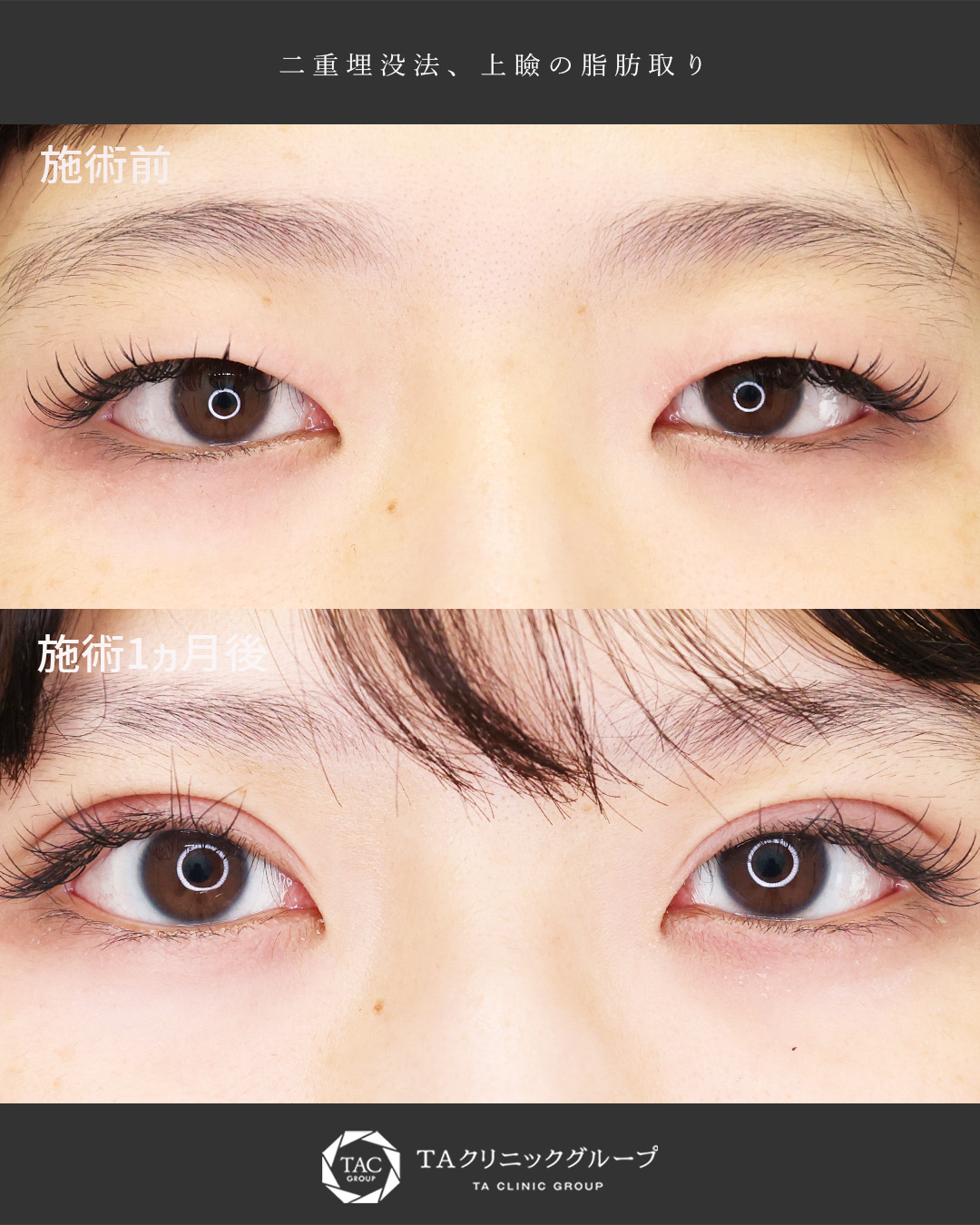 眠たい目元を印象的な目元に|二重埋没法で叶えるパッチリ目元【Mix型】