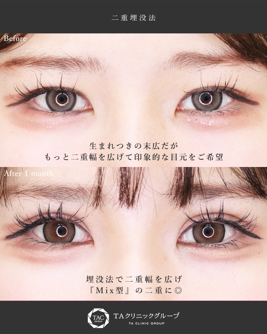 二重埋没法の症例写真 施術前後 