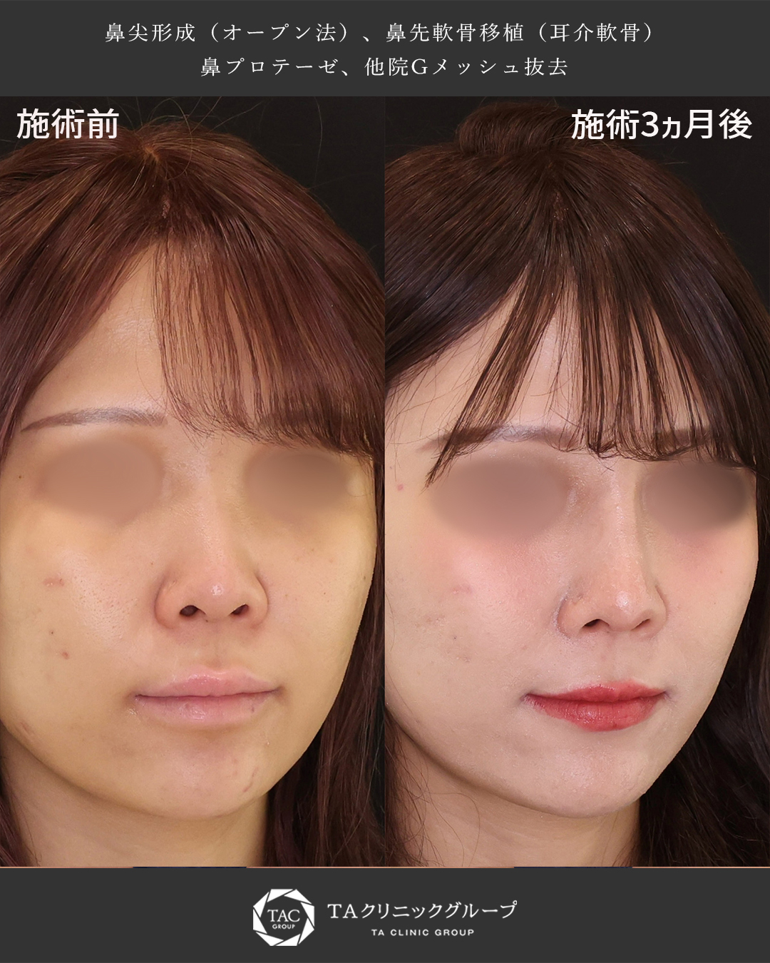 鼻尖形成・鼻尖縮小/隆鼻術(プロテーゼ・自家組織)の症例写真 施術前後