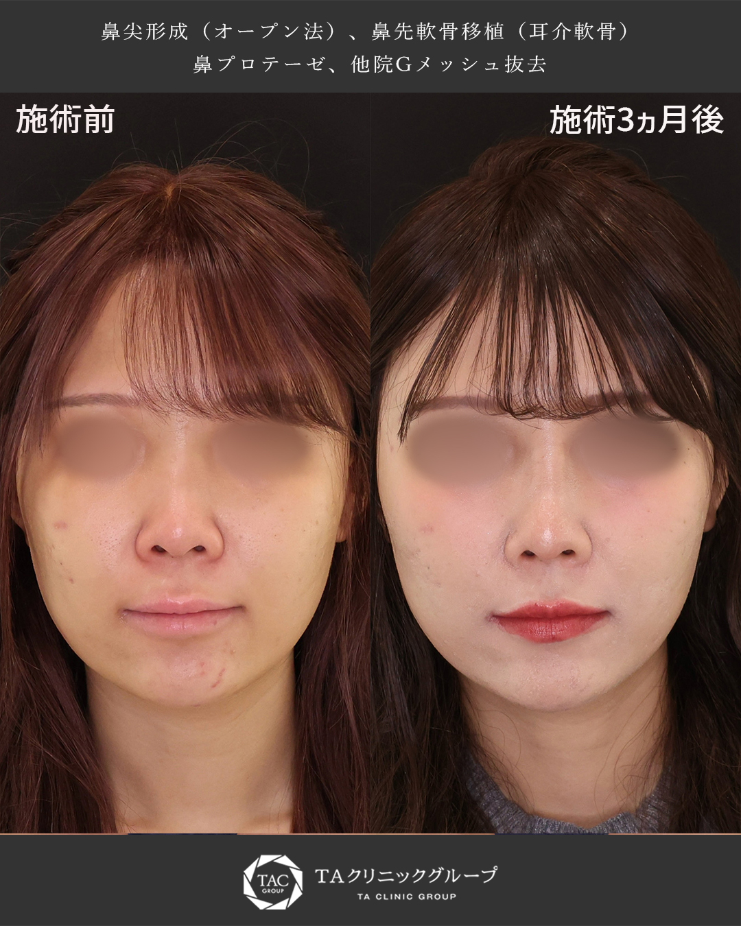 鼻尖形成・鼻尖縮小/隆鼻術(プロテーゼ・自家組織)の症例写真 施術前後