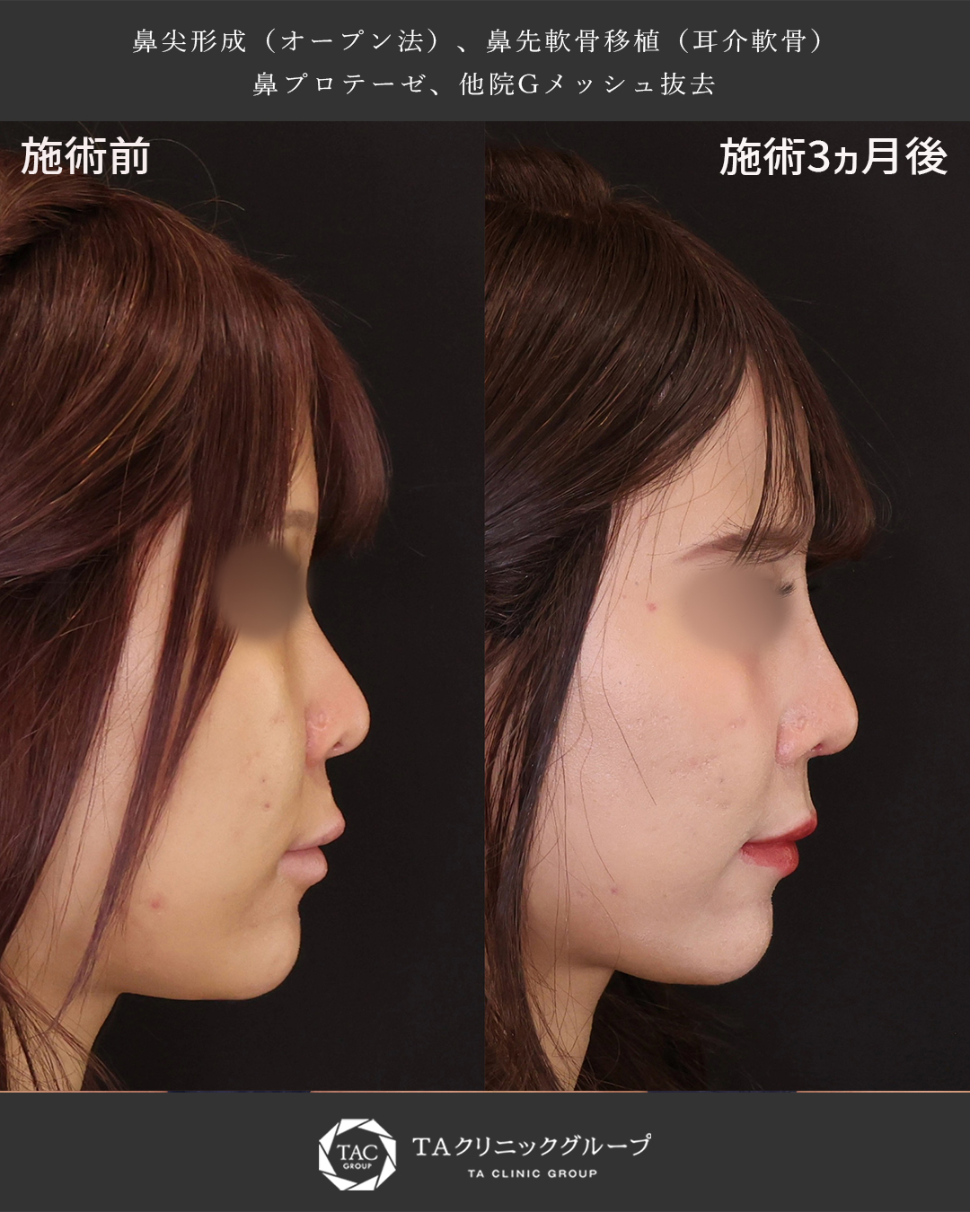 鼻尖形成・鼻尖縮小/隆鼻術(プロテーゼ・自家組織)の症例写真 施術前後