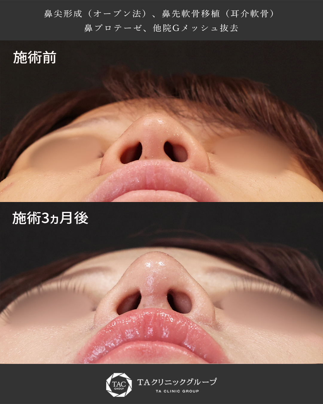 鼻尖形成・鼻尖縮小/隆鼻術(プロテーゼ・自家組織)の症例写真 施術前後