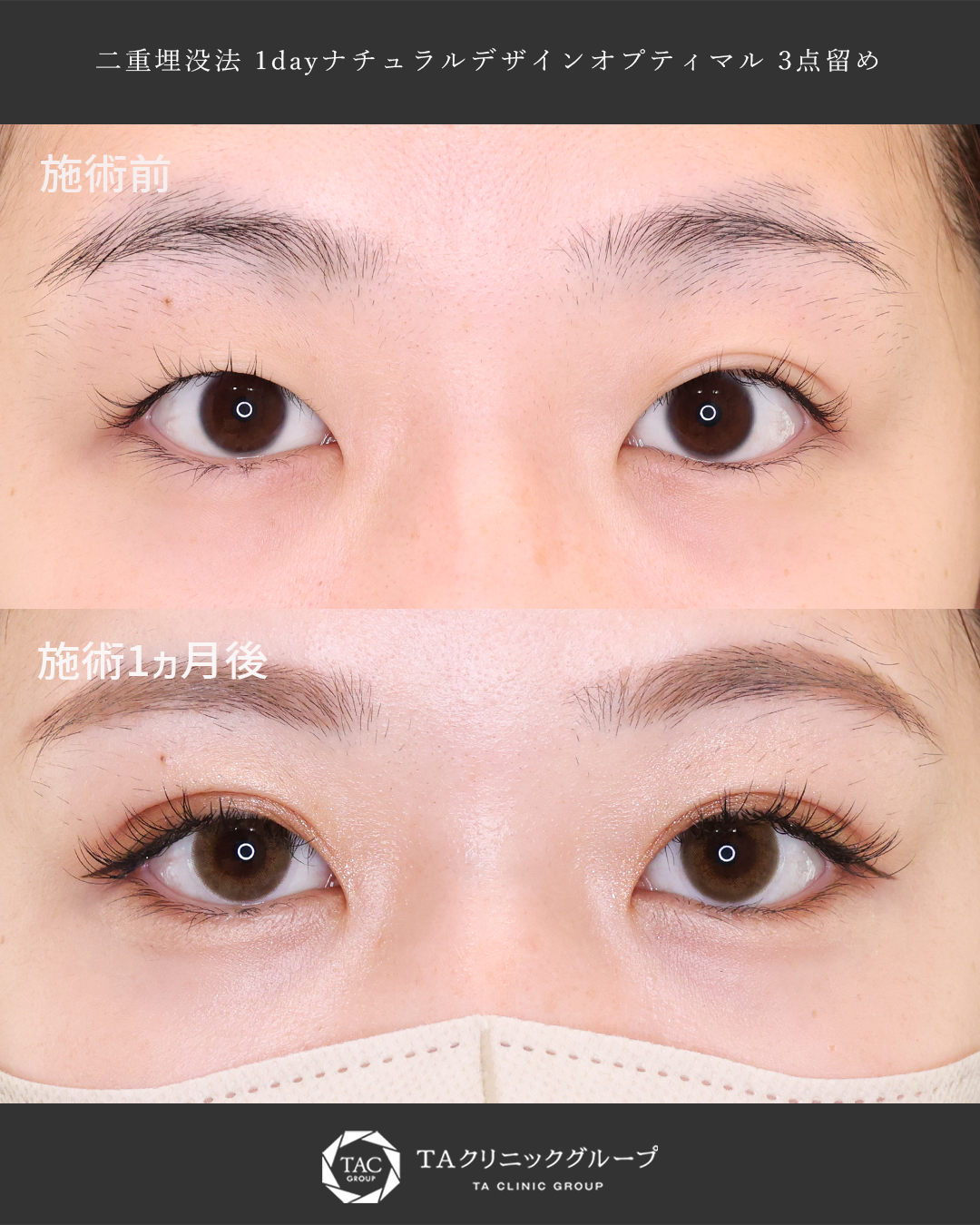 切開ナシで理想の二重に！【Dr.もりもり】