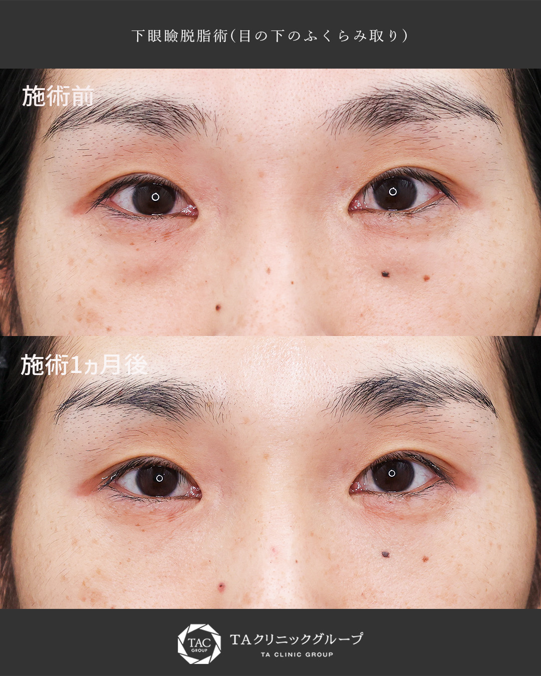 【目の下の膨らみ取り】疲れて見える目元を改善◎