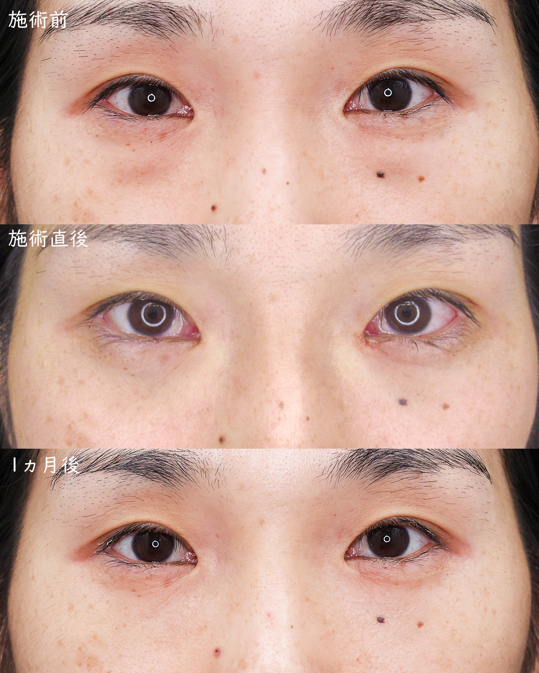 下眼瞼脱脂術（目の下のたるみ取り・目の下の脂肪ふくらみ取り）の症例写真 施術前後 