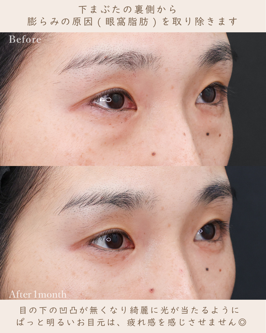 下眼瞼脱脂術（目の下のたるみ取り・目の下の脂肪ふくらみ取り）の症例写真 施術前後 