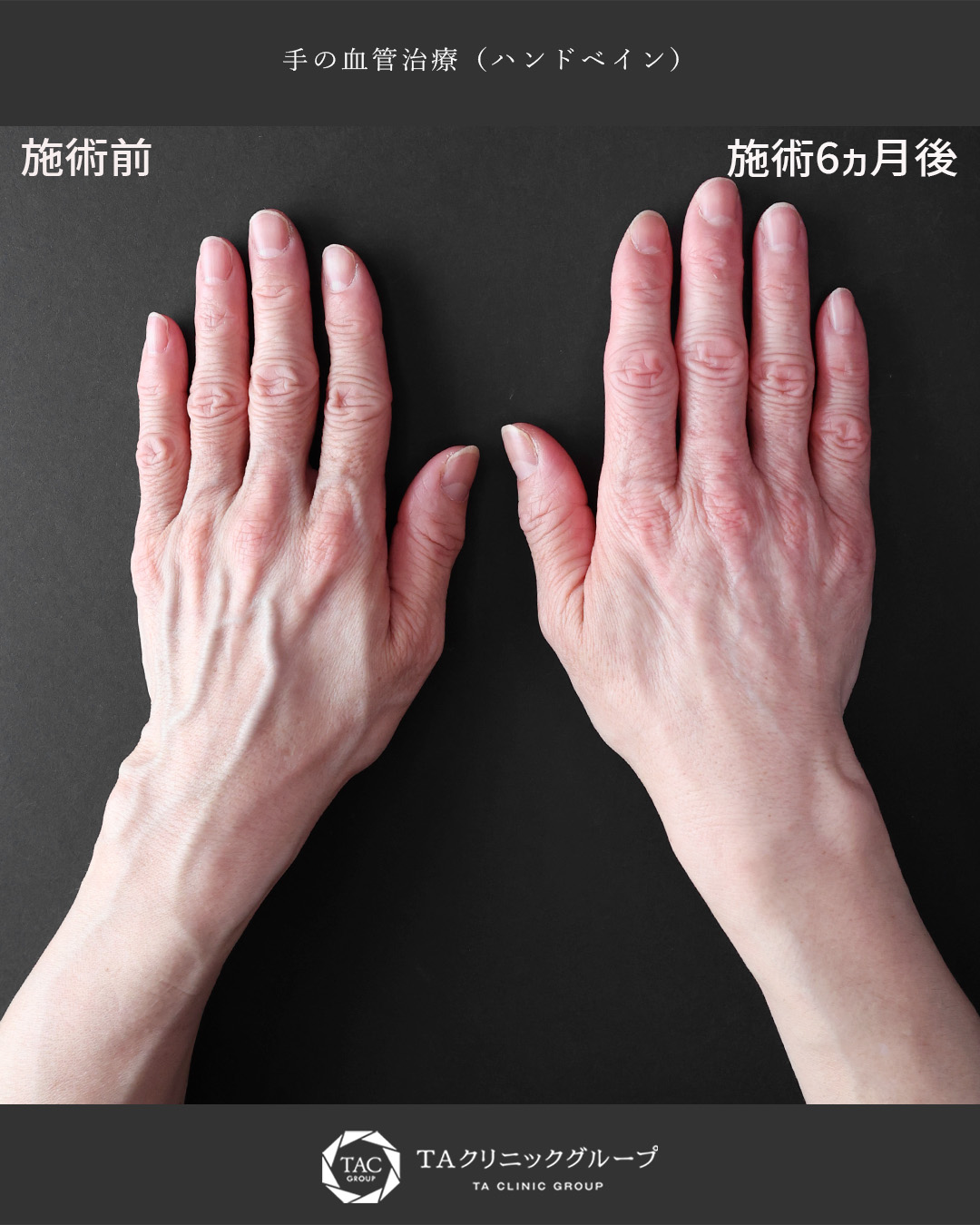 にょろにょろと浮き出た血管を解消◎【手の血管治療】