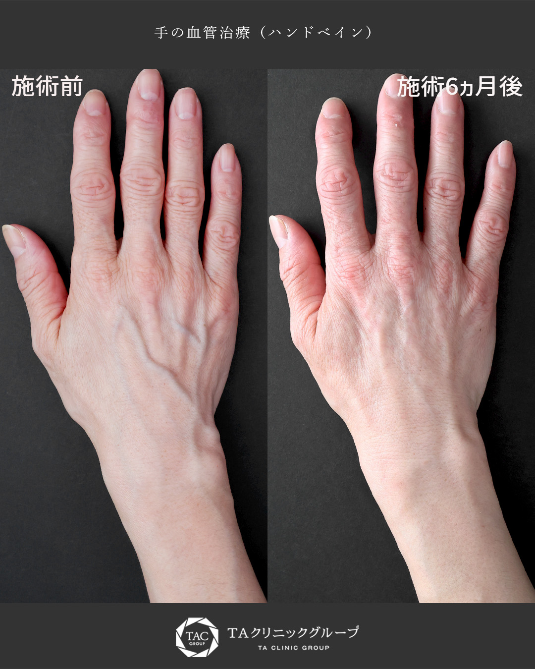 ハンドベイン（手のアンチエイジング・血管治療）の症例写真 施術前後 
