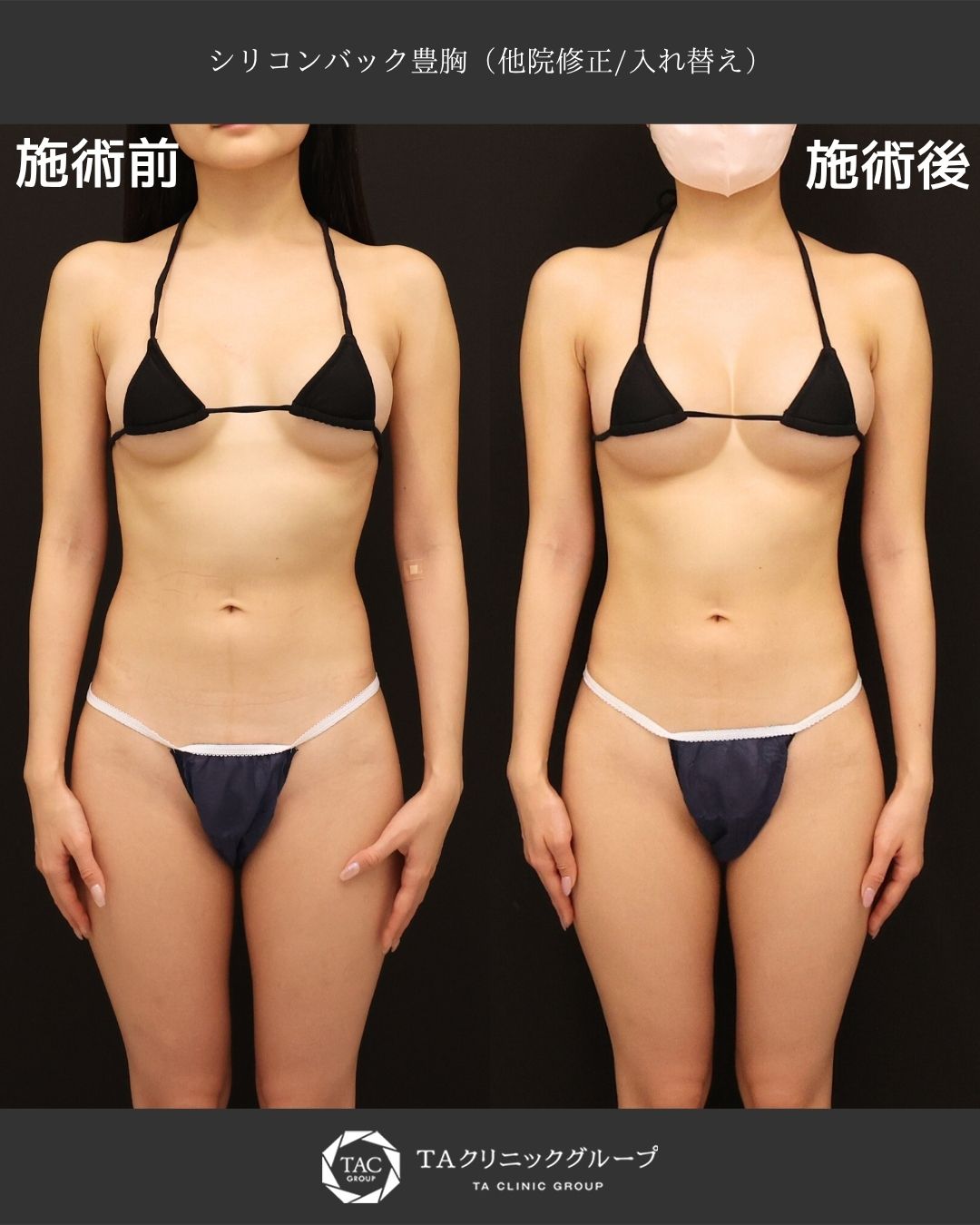 【安全安心の女医が執刀】シリコンバック豊胸でも自然に大きく