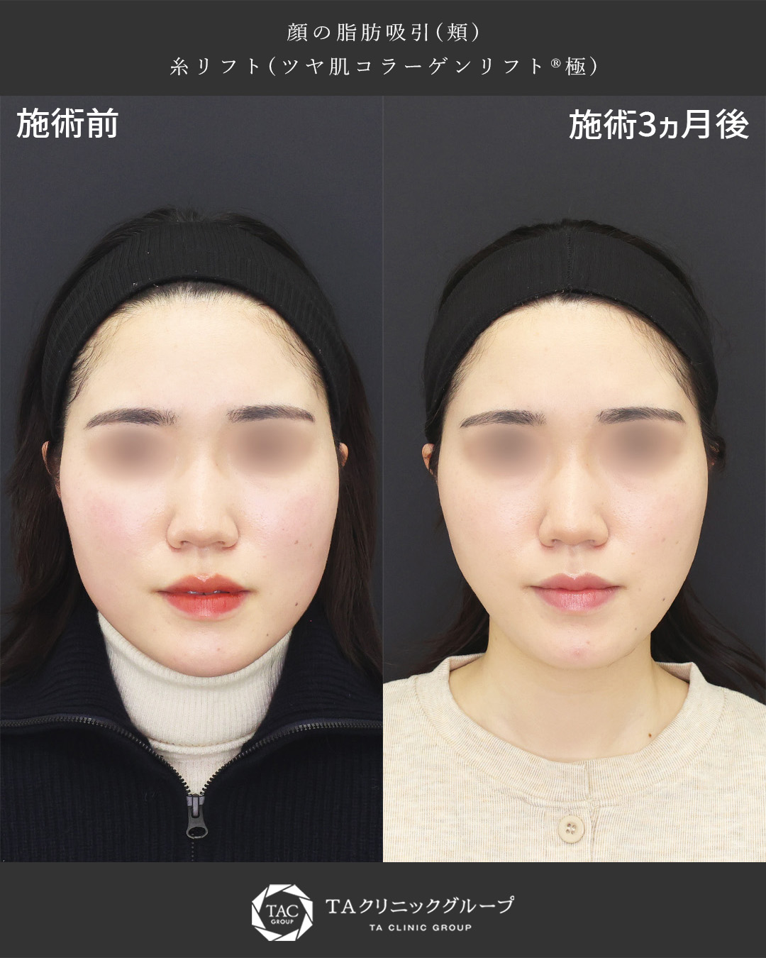 頬のもたつき改善【小顔整形で憧れのフェイスラインに】