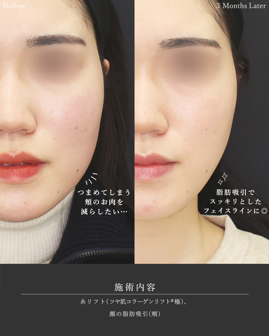 顎下の脂肪吸引/TAC式 ツヤ肌コラーゲンリフト®の症例写真 施術前後 
