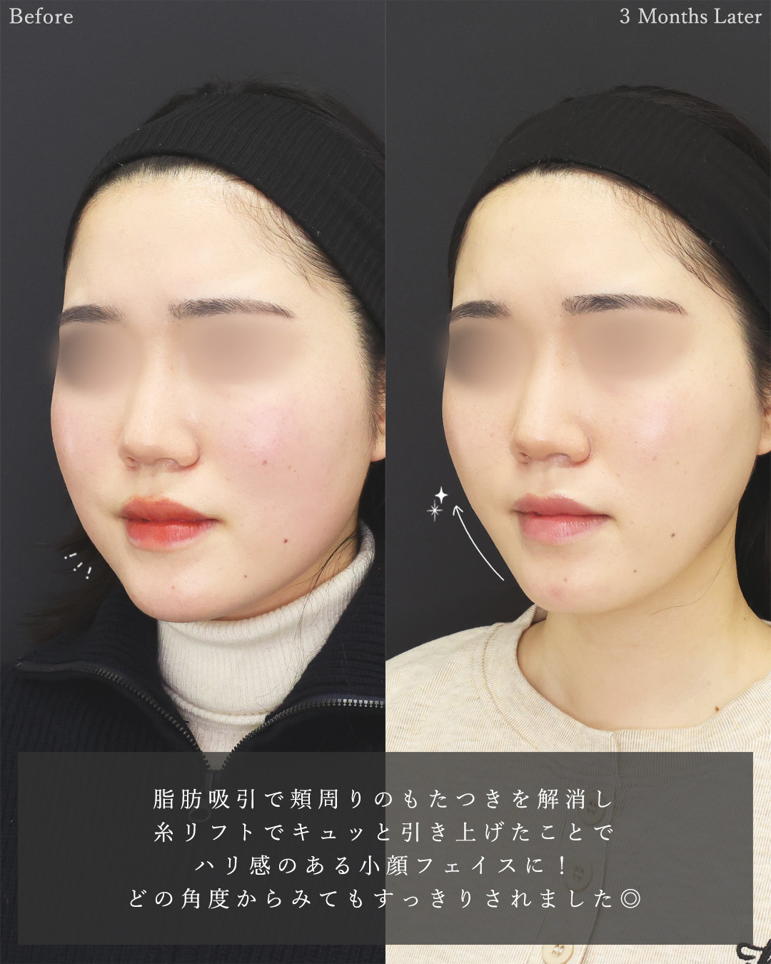 顎下の脂肪吸引/TAC式 ツヤ肌コラーゲンリフト®の症例写真 施術前後 
