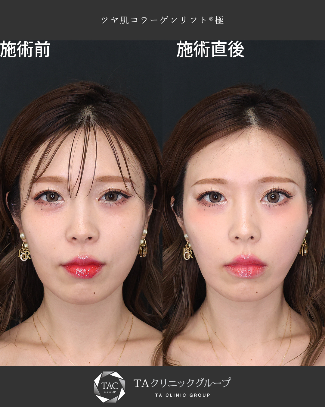 糸リフトでほうれい線を引き伸ばす！りさ先生の小顔術