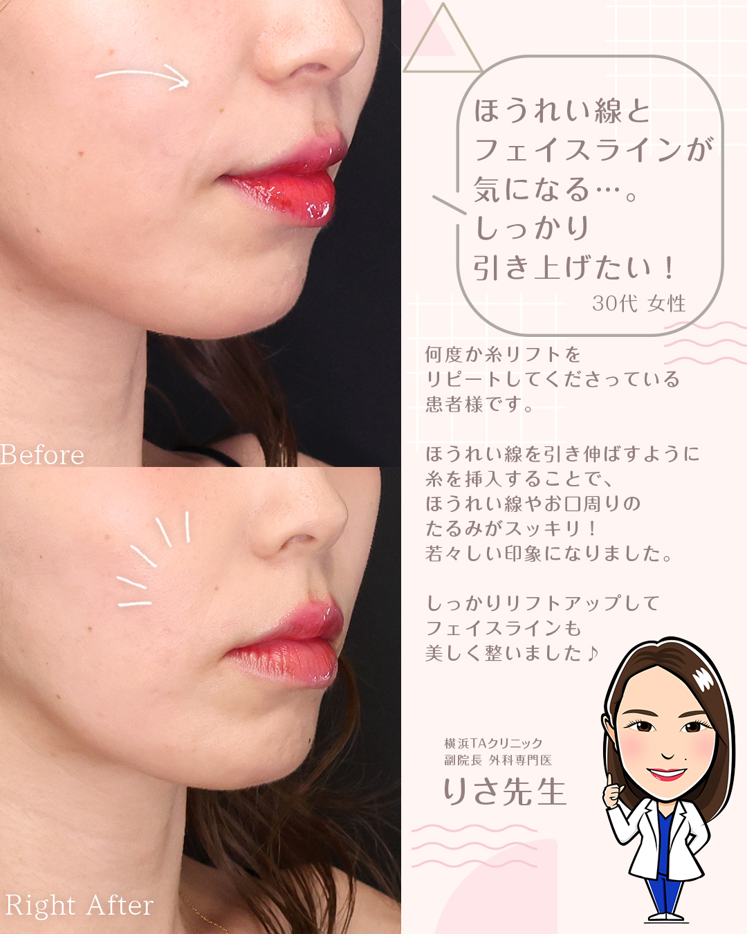 TAC式 ツヤ肌コラーゲンリフト®の症例写真 施術前後 