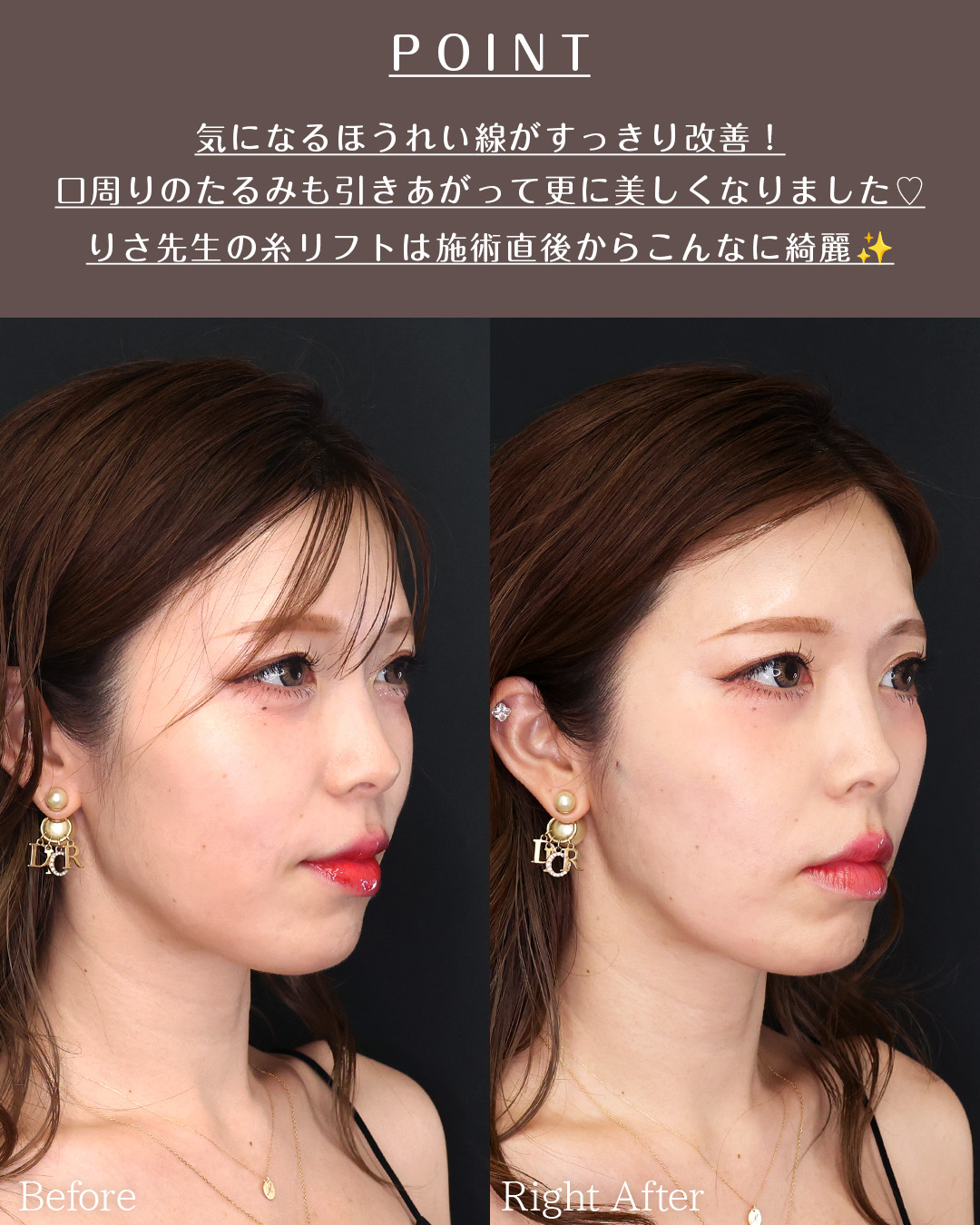 TAC式 ツヤ肌コラーゲンリフト®の症例写真 施術前後 