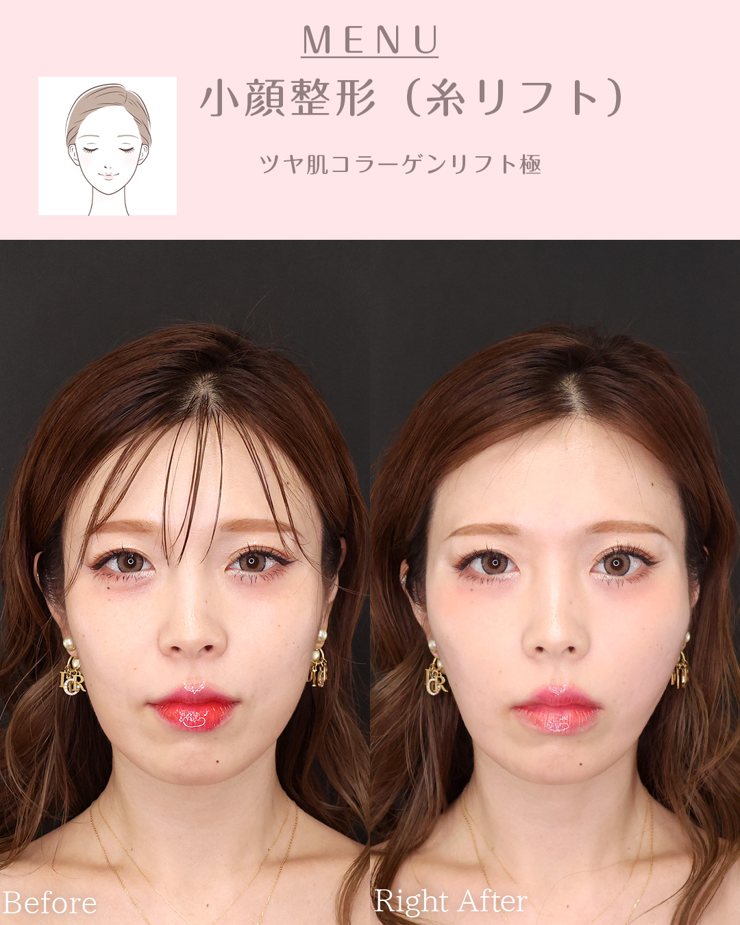 TAC式 ツヤ肌コラーゲンリフト®の症例写真 施術前後 