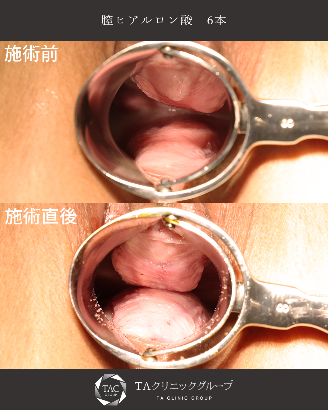 【膣ヒアルロン酸】産後の尿漏れにも効果的！即効性なら膣ヒアル