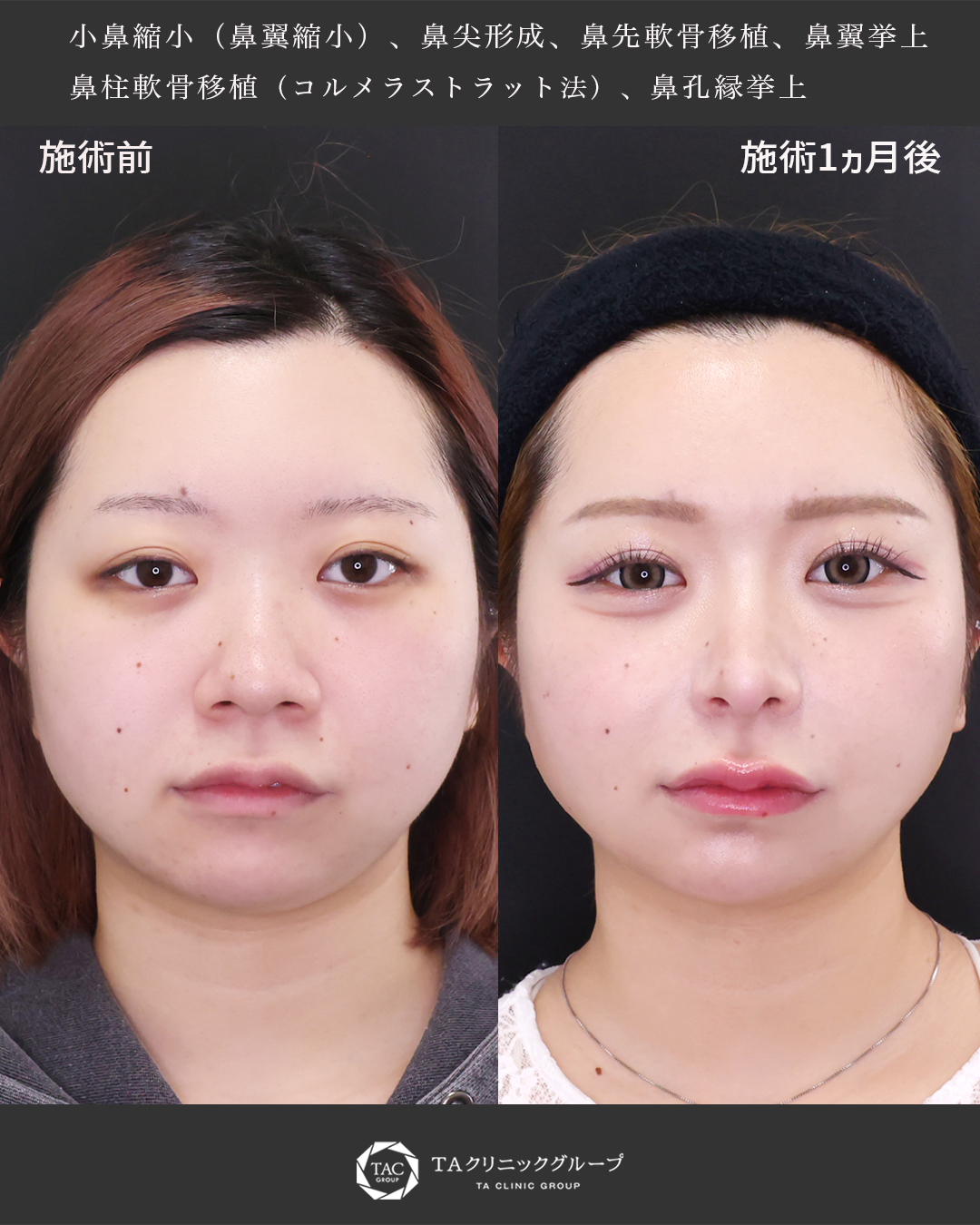 【小鼻縮小】小鼻の広がりを抑えたバランス鼻整形