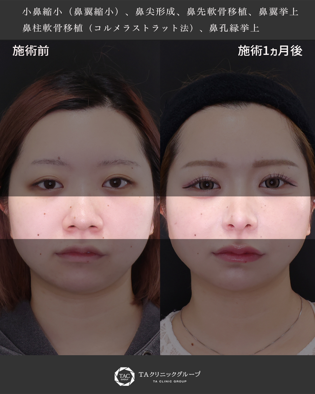 鼻尖形成・鼻尖縮小/鼻先軟骨移植/鼻翼挙上術の症例写真 施術前後 