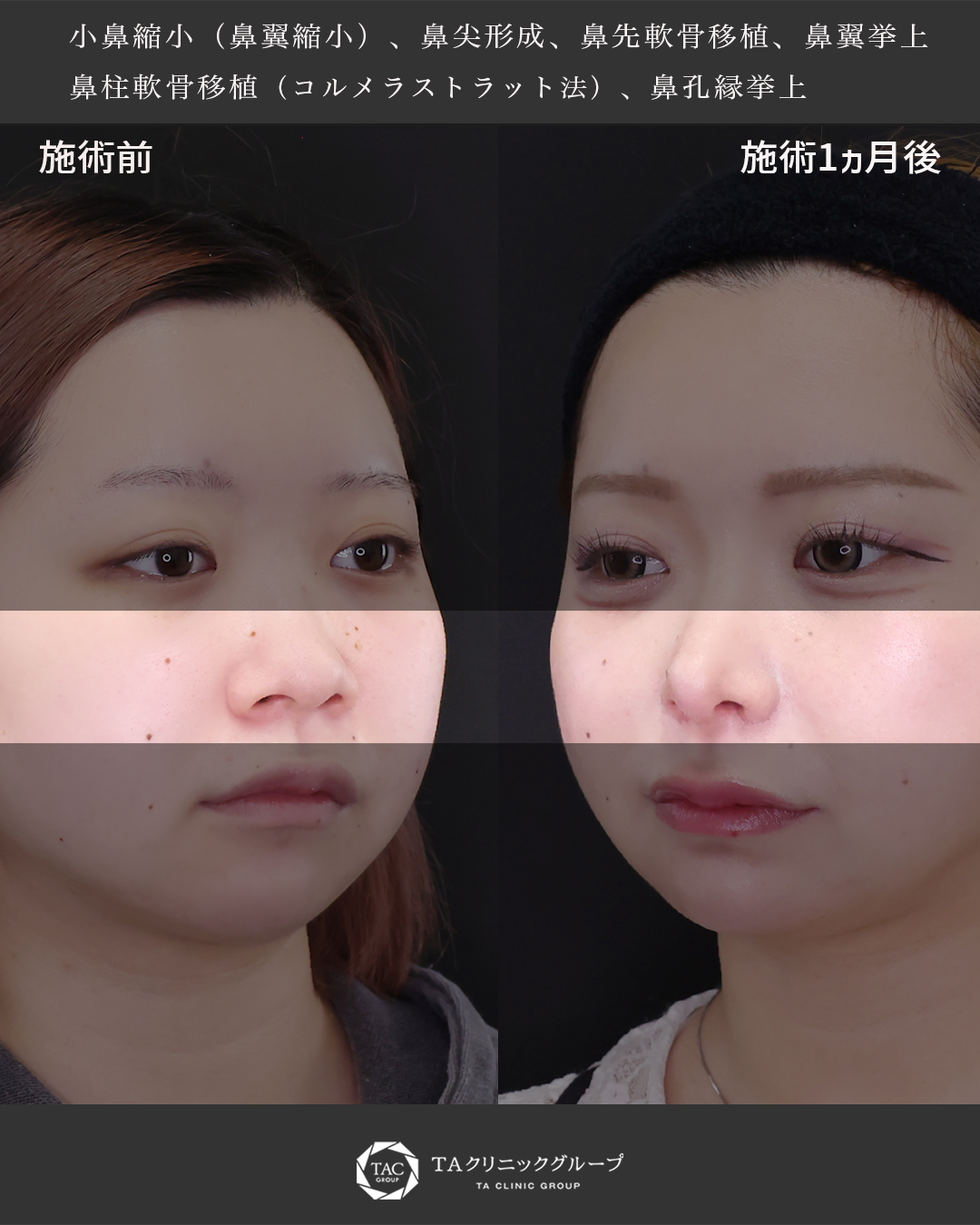 鼻尖形成・鼻尖縮小/鼻先軟骨移植/鼻翼挙上術の症例写真 施術前後 