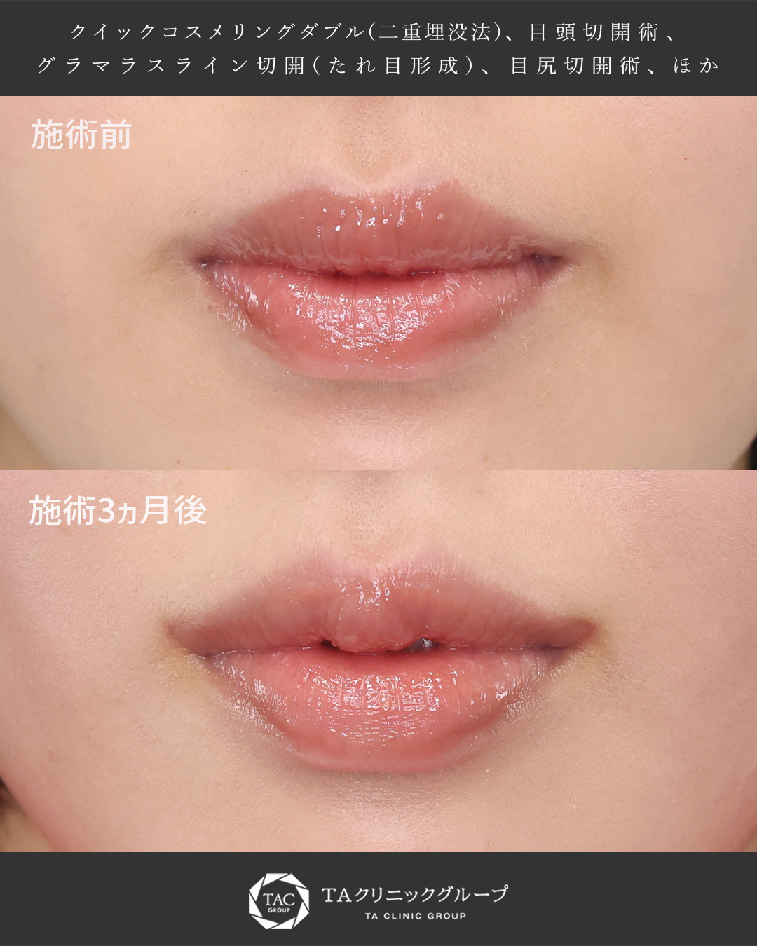 ナチュラルなM字リップで印象チェンジ｜口角挙上＋M字形成で可愛らしい唇に！