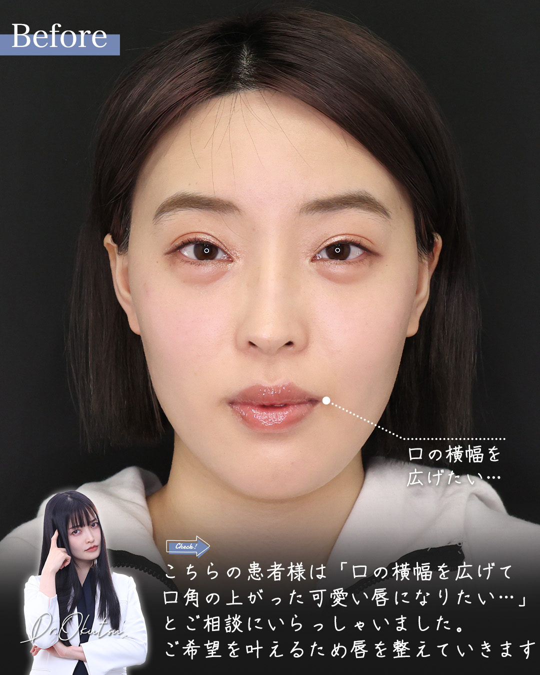 口角挙上・リフト（マイクロ切開法・内側法/口内法）/M字リップ形成術の症例写真 施術前後 