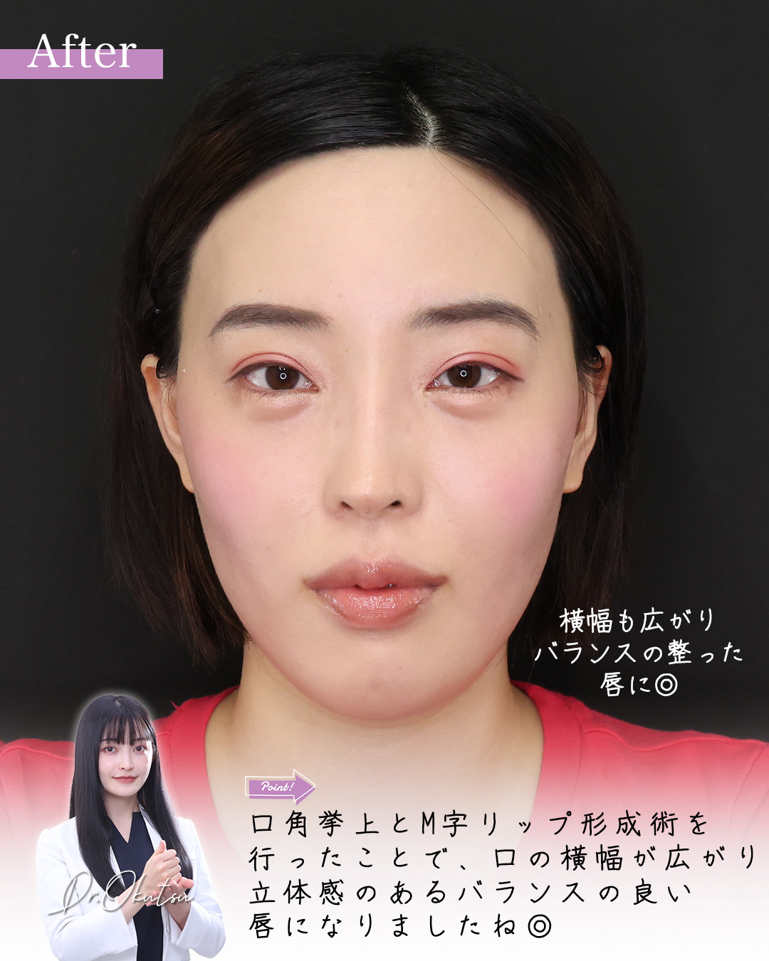 口角挙上・リフト（マイクロ切開法・内側法/口内法）/M字リップ形成術の症例写真 施術前後 