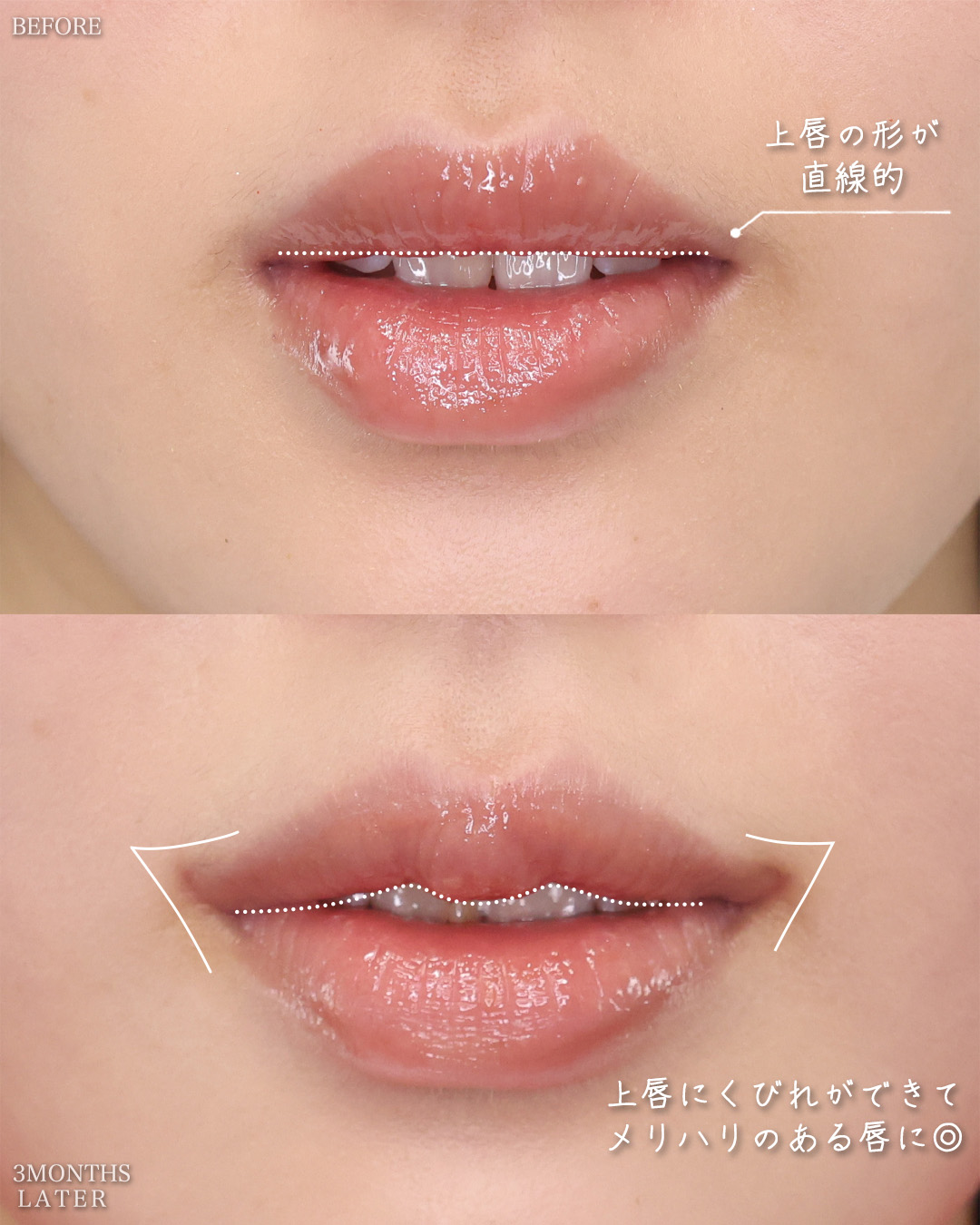 口角挙上・リフト（マイクロ切開法・内側法/口内法）/M字リップ形成術の症例写真 施術前後 
