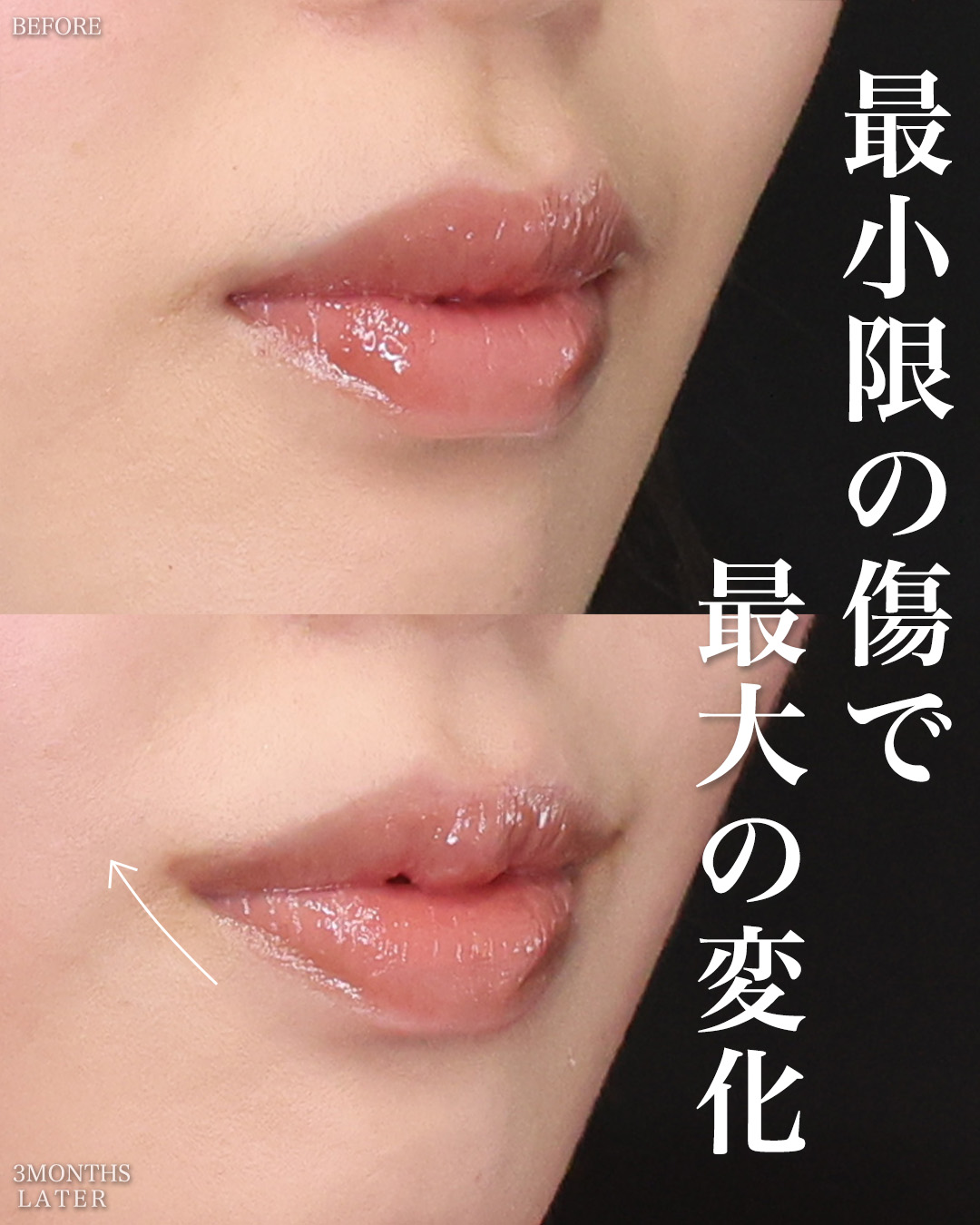 口角挙上・リフト（マイクロ切開法・内側法/口内法）/M字リップ形成術の症例写真 施術前後 