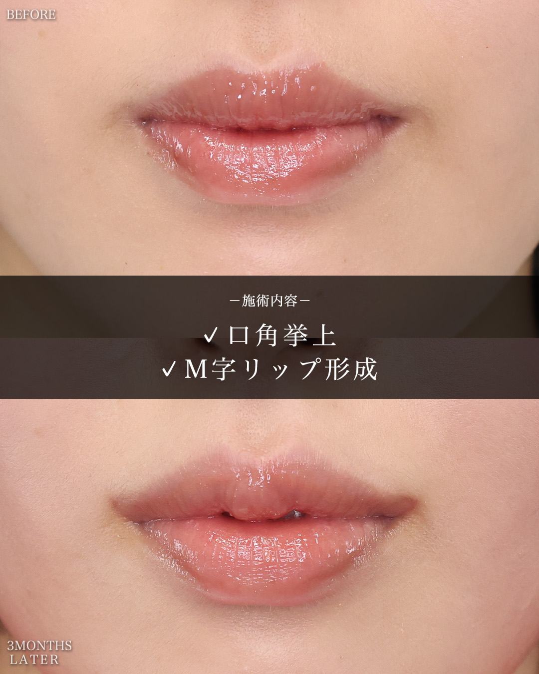口角挙上・リフト（マイクロ切開法・内側法/口内法）/M字リップ形成術の症例写真 施術前後 
