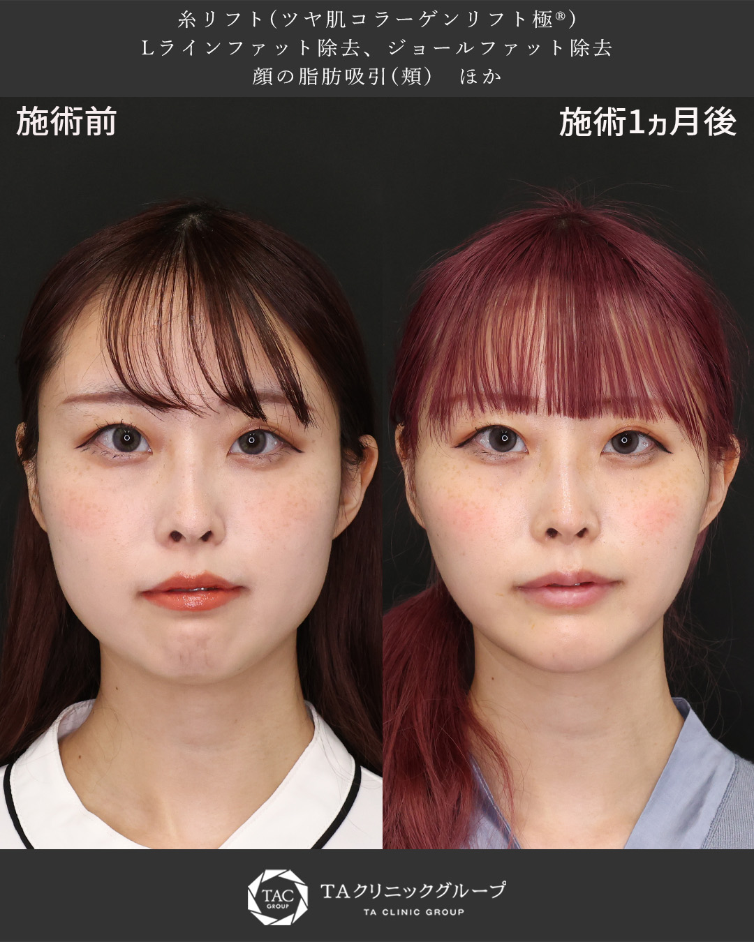 整形感ゼロで自然に垢抜け！エラ張りを解消してフェイスラインすっきり小顔に｜20代女性症例