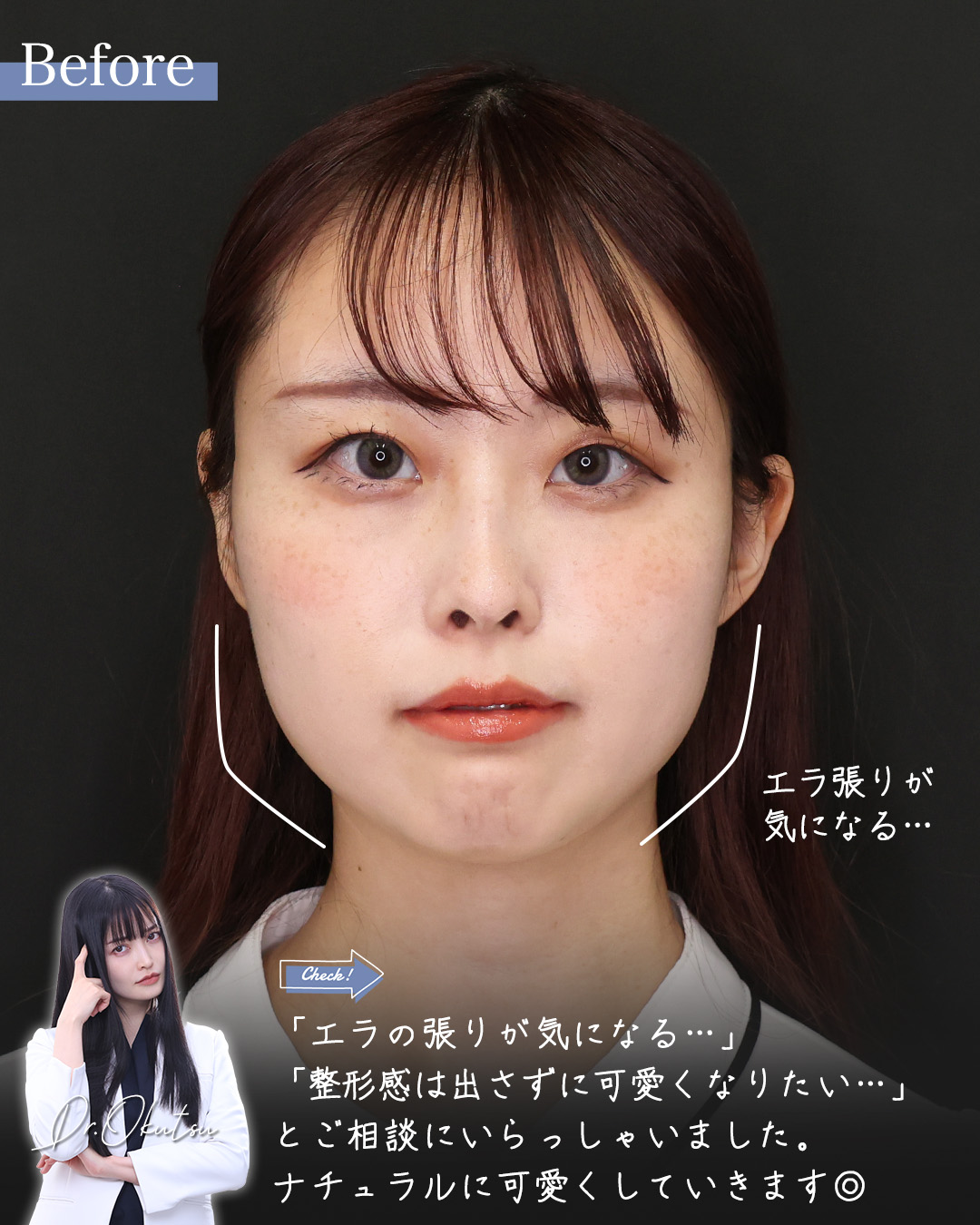 TAC式 ツヤ肌コラーゲンリフト®/顎下の脂肪吸引/ジョールファット除去の症例写真 施術前後 