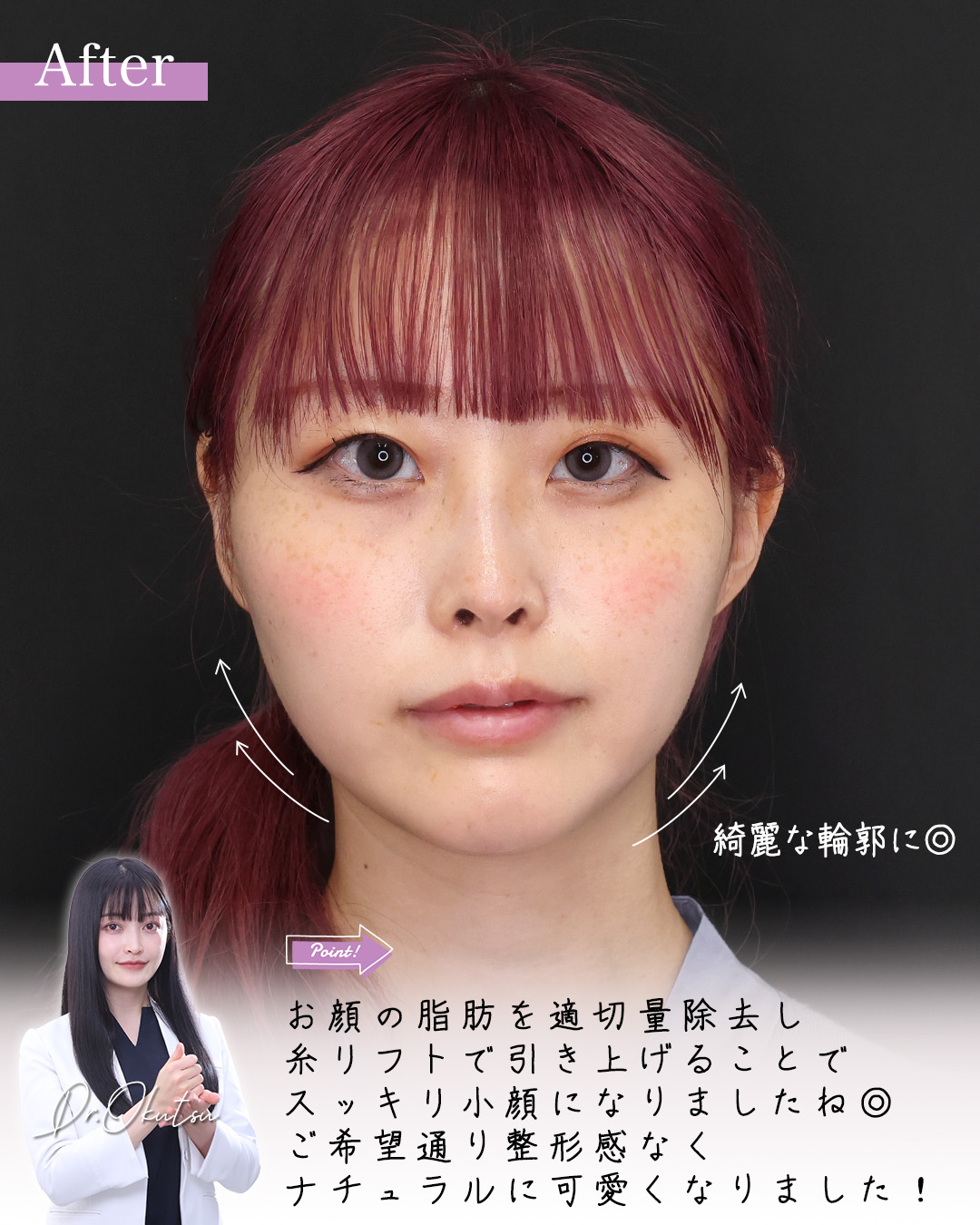 TAC式 ツヤ肌コラーゲンリフト®/顎下の脂肪吸引/ジョールファット除去の症例写真 施術前後 