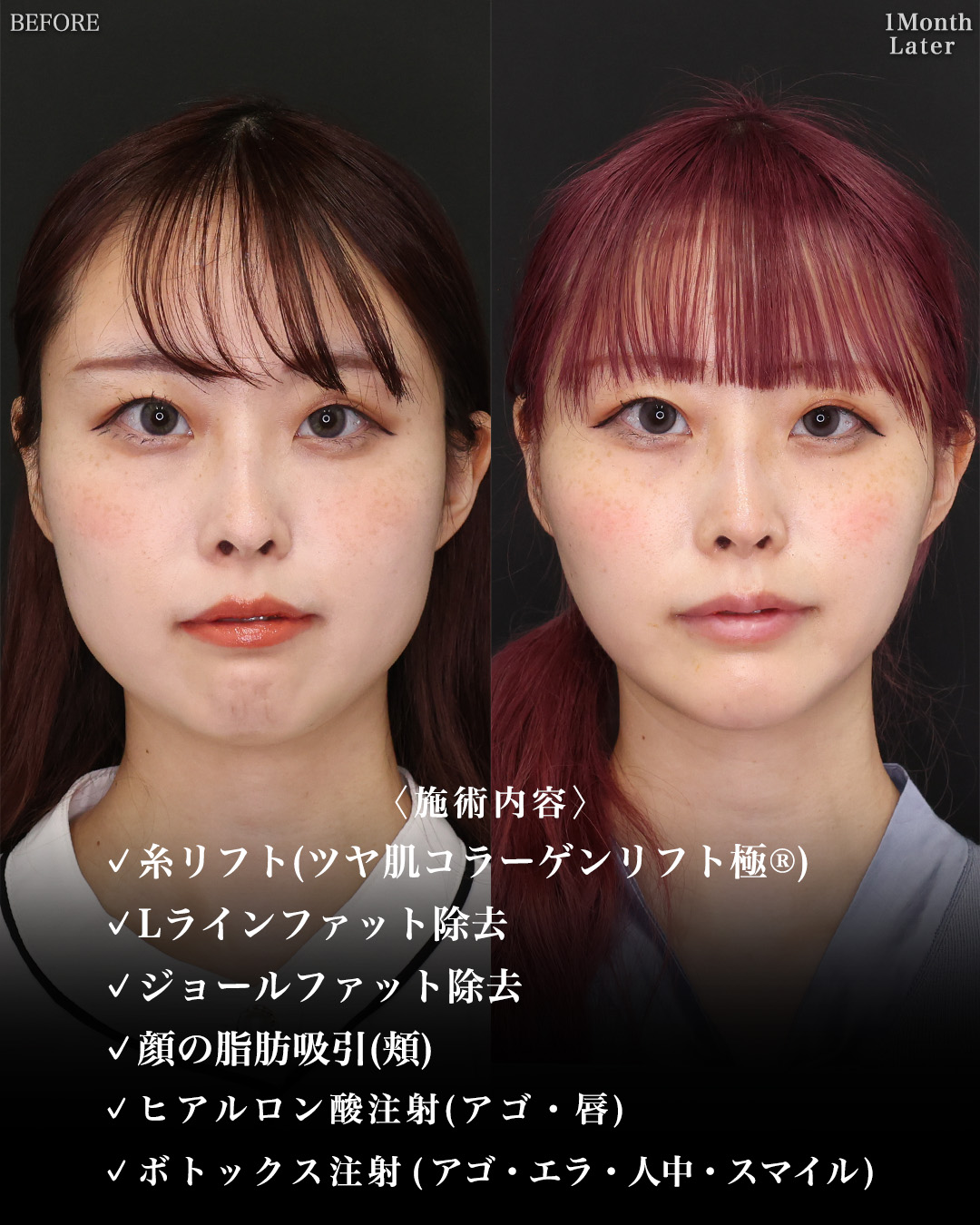 TAC式 ツヤ肌コラーゲンリフト®/顎下の脂肪吸引/ジョールファット除去の症例写真 施術前後 