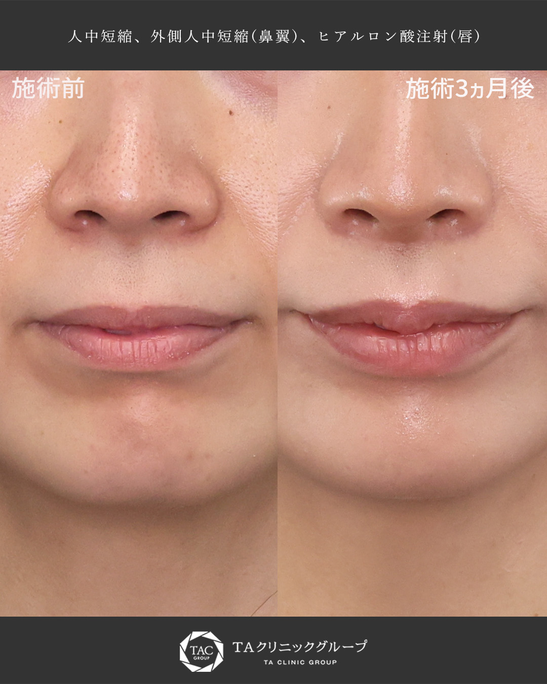 老け見えの原因“人中の長さ”を解消して、若々しく垢抜けた印象に