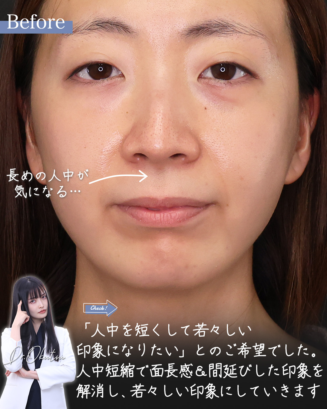 人中短縮術(リップリフト)・外側人中短縮術/ヒアルロン酸注射：その他の症例写真 施術前後 